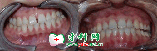 invisalign(invisalign隐适美牙套好不好)